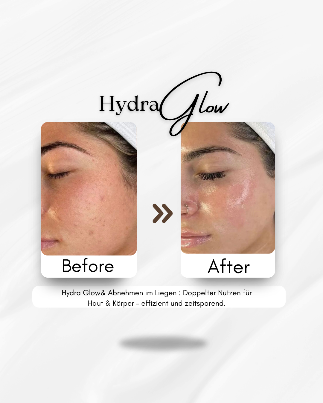 Vorher-Nachher-Vergleich einer Hydra-Glow-Behandlung